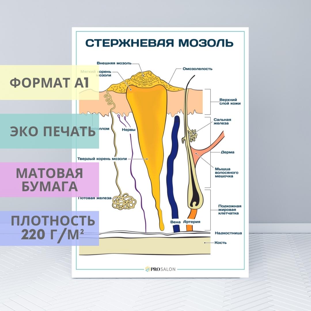 Мозоль текст. Стержневая мозоль плакат. Стержневая мозоль схема. Стержневая мозоль средство крио. Род существительных мозоль.